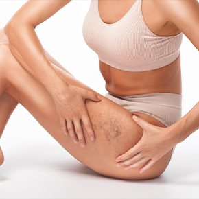 Spider veins on the lower leg, addressed with vein treatment in Arcadia