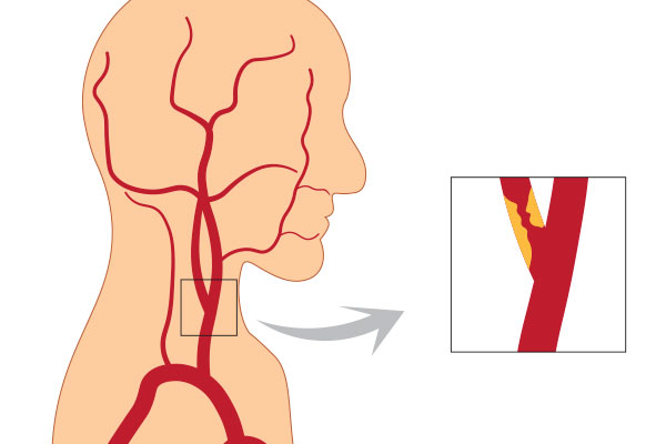 Carotid Artery Blockage and Aortic Aneurysm Treatment for Venous Disease