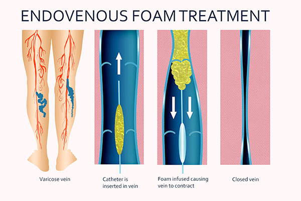 Before and after results of treatment for venous disease