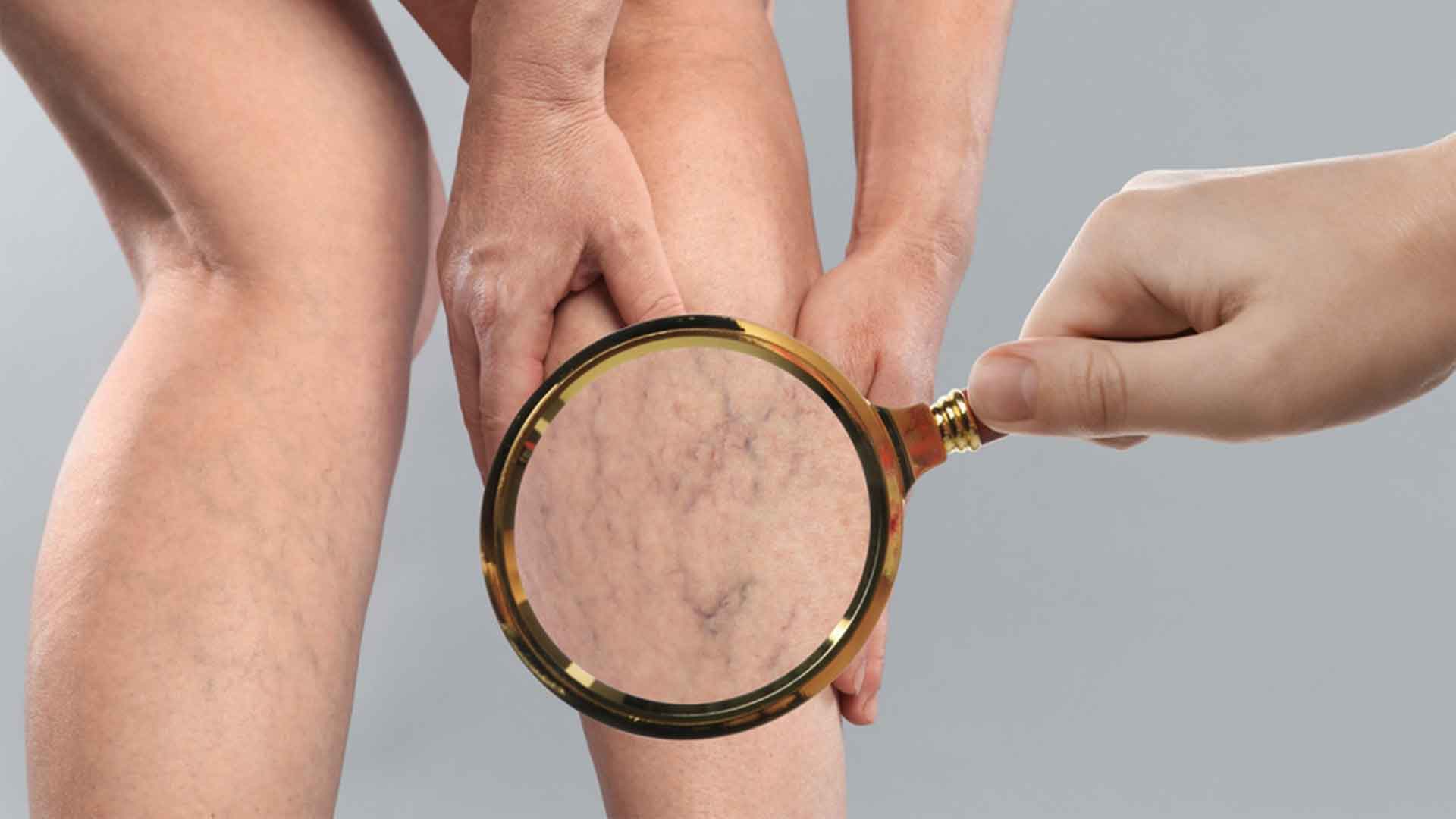 Expert insights on spider veins in our vein health blog
