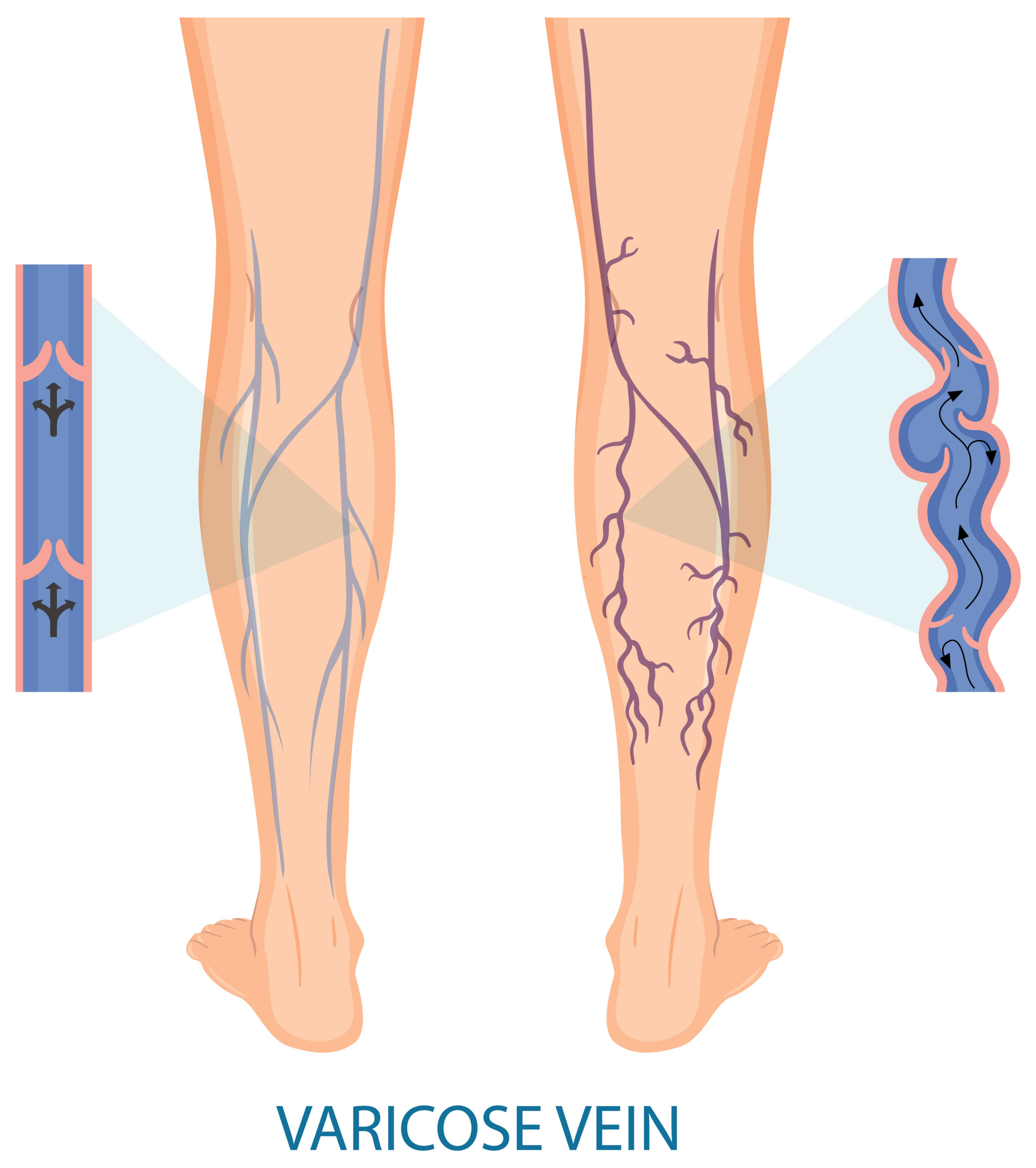 are varicose veins genetic family history risk